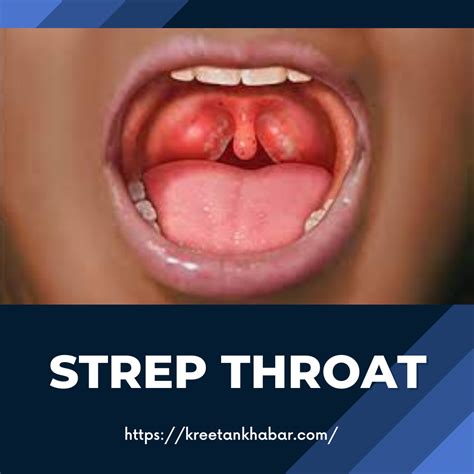 Understanding Strep Throat Symptoms Causes And Treatment 2023