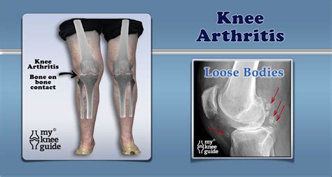 Symptomatic Osteoarthritis Of The Knee Occurs In 6 Of Adults Over The
