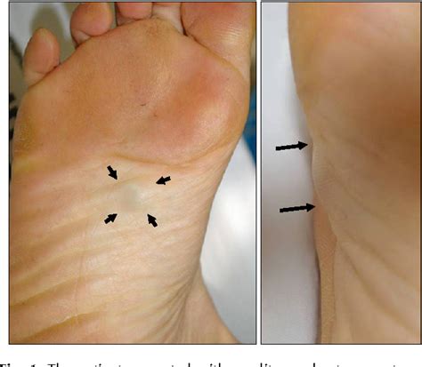 What About Ganglion Cysts On The Foot Ganglion Cysts Information Reverasite