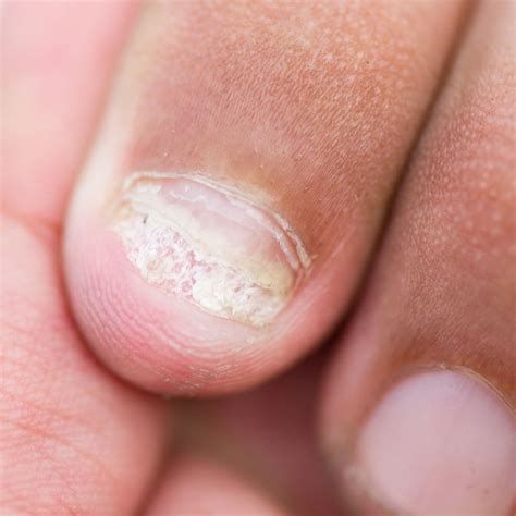 Doenças De Unhas Com Fotos