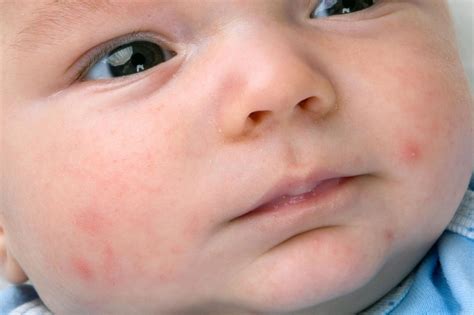 Skin Rashes In Babies Nidirect