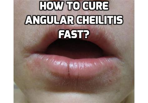 Signs Of Angular Cheilitis Will Nearly Show Up At The Edges Of The