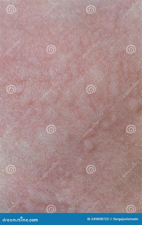 Urticaria On The Skin Red Spots Of An Allergic Reaction On The Skin Of