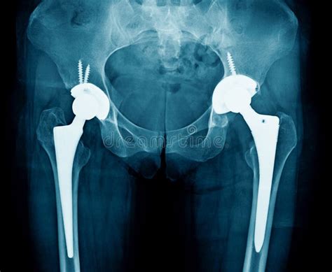 Hip Replacement Stock Image Image Of Anatomy Hospital 27730413