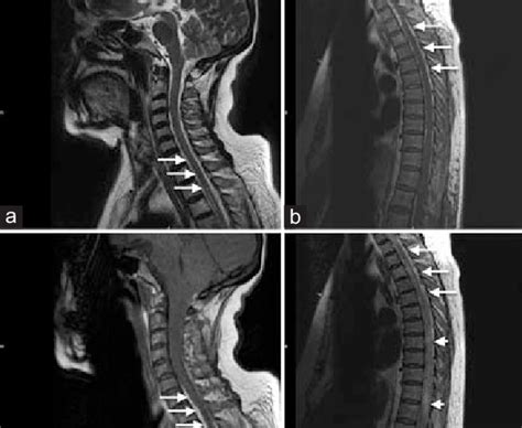 A Cervical Spine T1 Weighted Mri B Cervical Spine T2 Weighted Mri