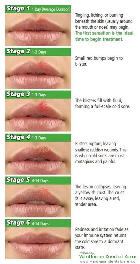Incorporating a healthy life maintain a good immune systems have been able to just prolong cold sores. Cold-Sores : Stages of progression of the lesion | Dental-Awareness | Pinterest | Cold Sore and ...