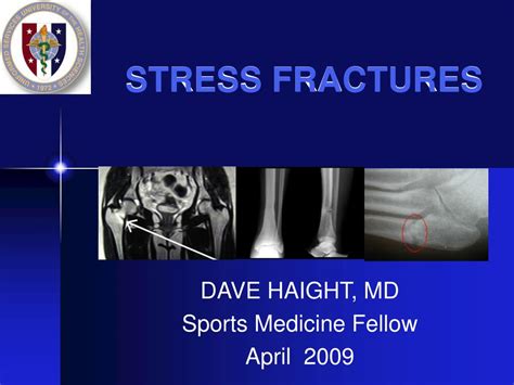 Ppt Stress Fractures Powerpoint Presentation Free Download Id235918