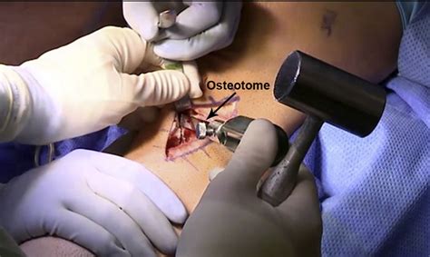 Anterolateral Biplanar Proximal Tibial Opening Wedge Osteotomy