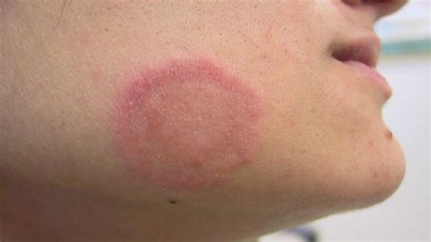 Skin Infection Causes Symptoms Diagnosis Treatment
