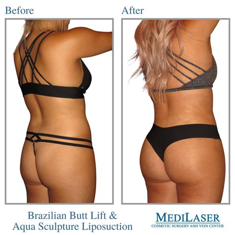Brazilian Butt Lift Before And After Medilaser Surgery And Vein Center