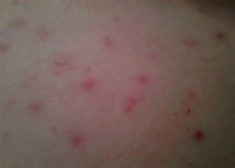 Red Spots On Breast Skin Side Bumps Patch No Lump No Pain Breast