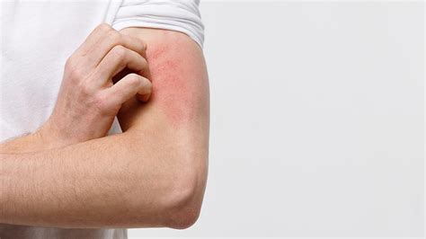 Acute And Chronic Hives And Rashes Causes And Treatments Ask The Doctor