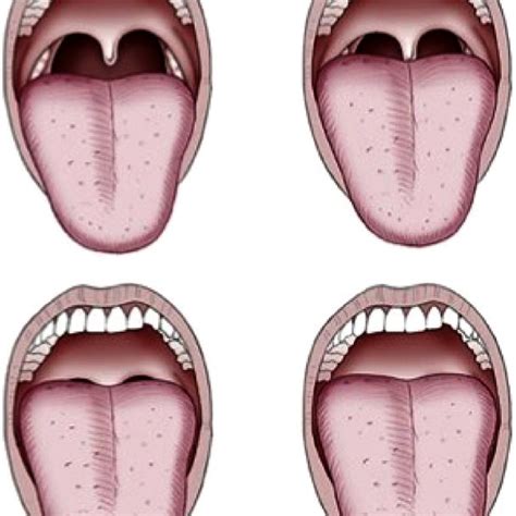 Mallampati Classification Class I Fully Visible Uvula And Soft