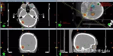脑瘤越长越大，体积增长3倍多！巨大脑膜瘤还能全切且不伤大脑吗？ 知乎