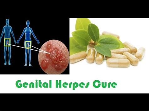 It has been available since 1982 in a topical form (as an ointment) and sold since 1985 in pill form. Herpes Cure - Dr. Oz. On Natural Herpes Treatment - A ...