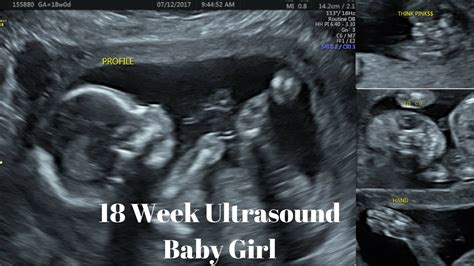 18 Weeks Pregnancy Ultrasound Pictures Pregnancywalls