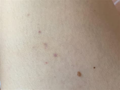 Woke Up With These Three Purple Dots On My Leg Any Ideas Why Rskin
