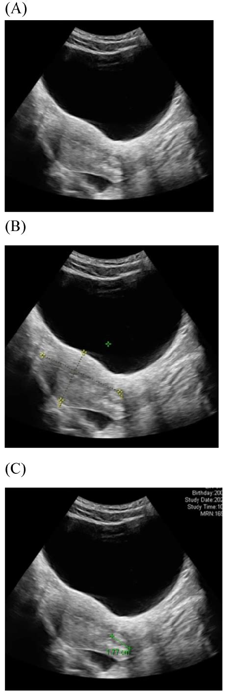 Transabdominal Ultrasound Image Shows A Longitudinal Section Of The