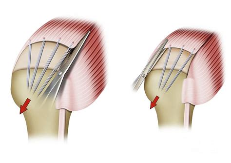 Rotator Cuff Shoulder Surgery Photograph By Maurizio De Angelisscience