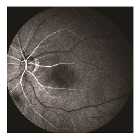 Acute Central Retinal Artery Occlusion With Cilioretinal Sparing Left