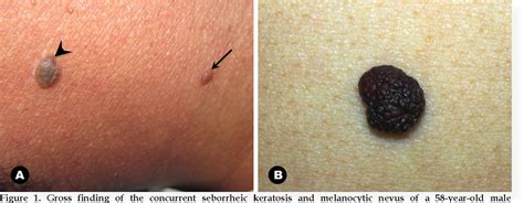 Pdf Concurrent Occurrence Of Seborrheic Keratosis And Melanocytic Nevus In The Same Lesion
