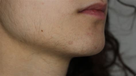 Top 168 How To Reduce Facial Hair Pcos Polarrunningexpeditions