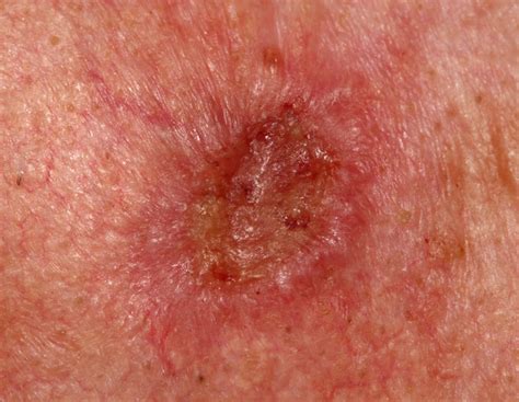 Squamous Cell Carcinoma Skin Cancer Questions Answered Scary Symptoms
