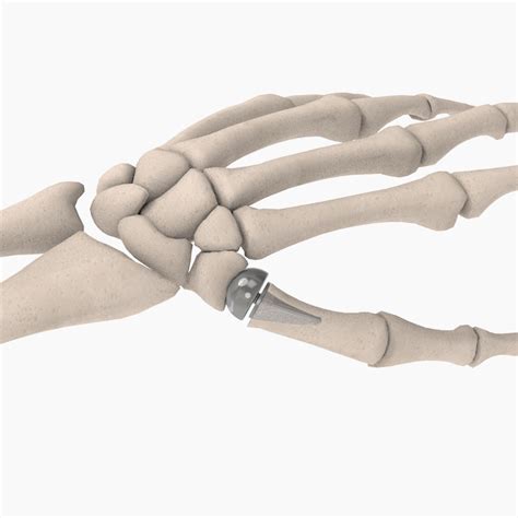 The Biopro Modular Thumb Implant A New Look At A Proven Procedure