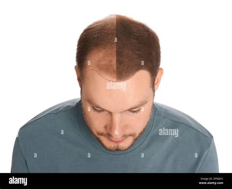 Man With Hair Loss Problem Before And After Treatment On White