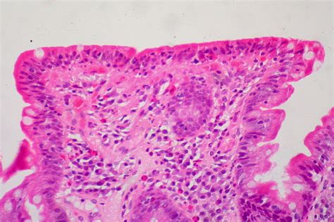 If you believe you have a medical emergency. Celiac Disease | Concise Medical Knowledge