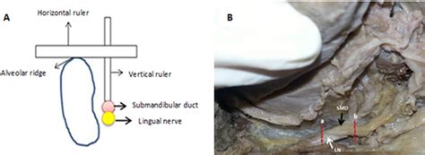 Submandibular Duct Cadaver