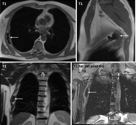 Mri Of The Chest Axial And Sagittal T1wi Coronal T2wi And Coronal T1