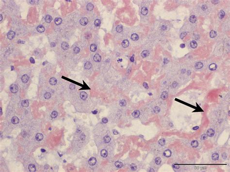 Hepatic Amyloidosis In A Cat Case Study Cytopath