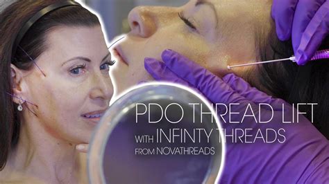 Novathreads Infinity Thread Lift Pdo Threads For Jawline Contouring