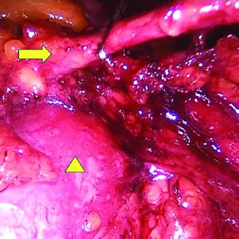 Intraoperative Photograph Showing The Inferior Mesenteric Artery Being