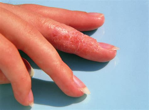 Eczema Affecting A Womanss Finger Photograph By Sheila Terryscience