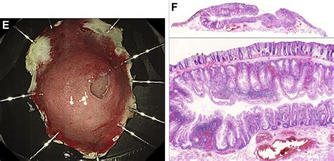 An Unusual Lesion In The Ascending Colon Gastroenterology
