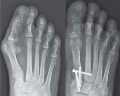 Hallux Valgus Ankle Osteoarthrosis And Adult Acquired Flatfoot