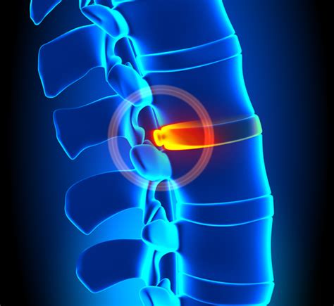 Using Spinal Decompression Therapy To Treat Herniated And Bulging Discs