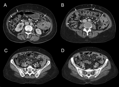 Contrast Enhanced Abdominal And Pelvis Computed Tomography Scans In The