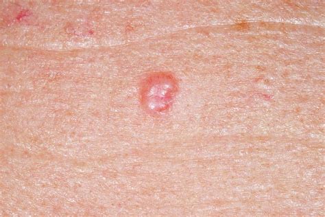 Basal Cell Carcinoma Skin Cancer Photograph By Dr P Marazzi Science