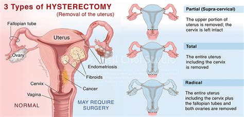 Gynecological Surgery — Mark J Godat Md Pa