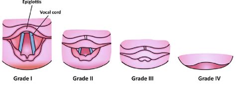 Difficult Laryngoscopy Cormack Lehane Grading Grade Iiv