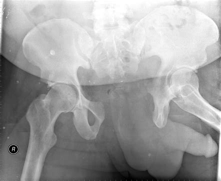 Pelvic Fractures Summary Radiology Reference Article Radiopaedia Org