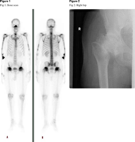 Figure 3 From Bone Scan Appearance Of Bilateral Femoral Head