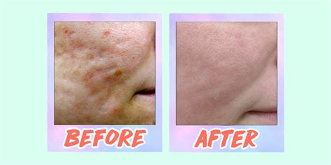Acne Scar Laser Treatment Before And After Before And After