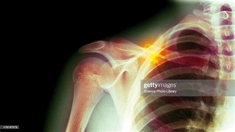 Fractured Collarbone Xray High Res Stock Photo Getty Images