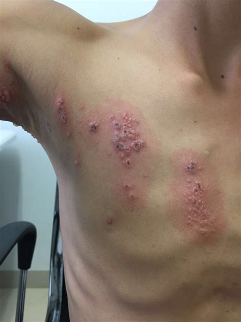 Herpes Zoster on chest