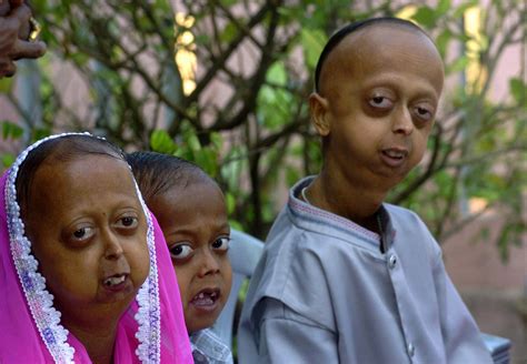 Fajarv Progeria Genetic Disorder