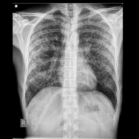 Miliary Tuberculosis Radiology Case Radiology